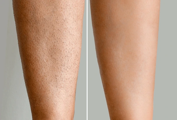 Comparație înainte și după epilarea laser pe picior
