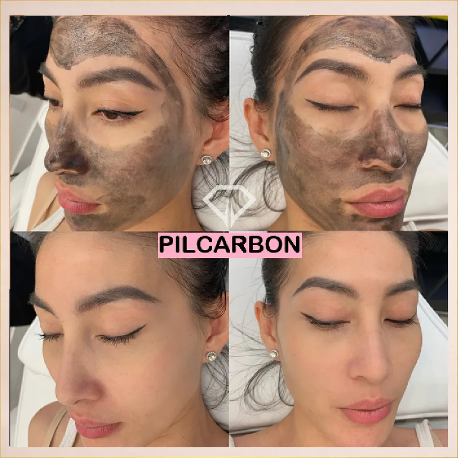 Peeling carbon înainte și după la English House Beauty Bistrița