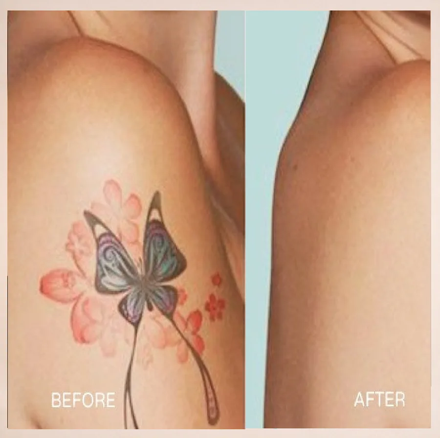 Tatuaj înainte și după ședințele PicoLaser la English House Beauty Bistrița