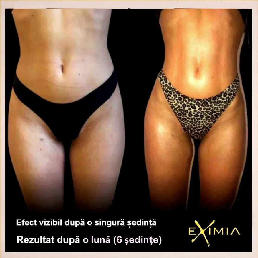 Remodelare corporală înainte și după protocol Eximia la English House Beauty Bistrița
