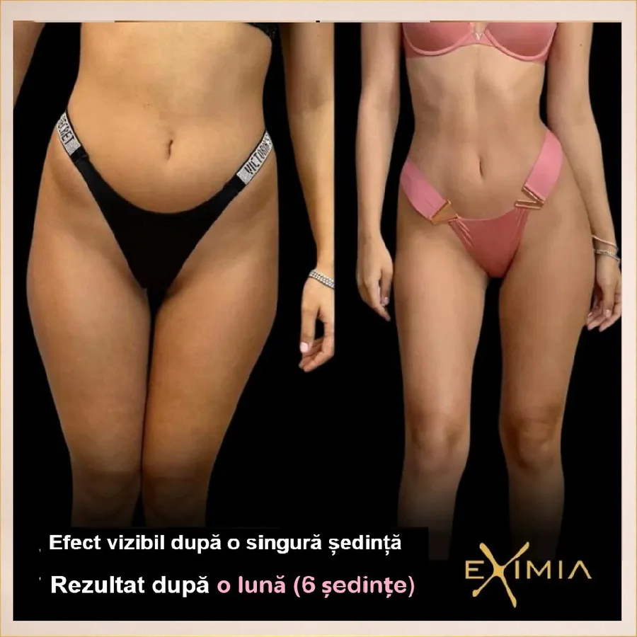 Rezultat corporal înainte și după ședințele Eximia la English House Beauty Bistrița