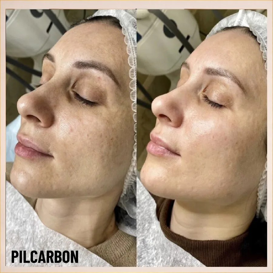 Aspectul tenului înainte și după peeling carbon la English House Beauty Bistrița