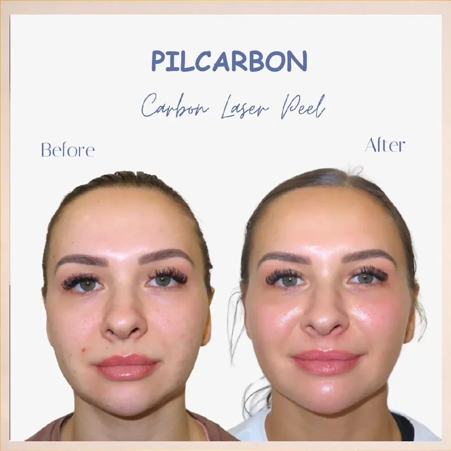 Ten înainte și după Carbon Laser Peel la English House Beauty Bistrița