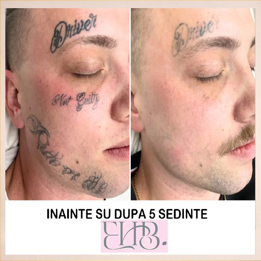 Tatuaj facial înainte și după cinci ședințe la English House Beauty Bistrița