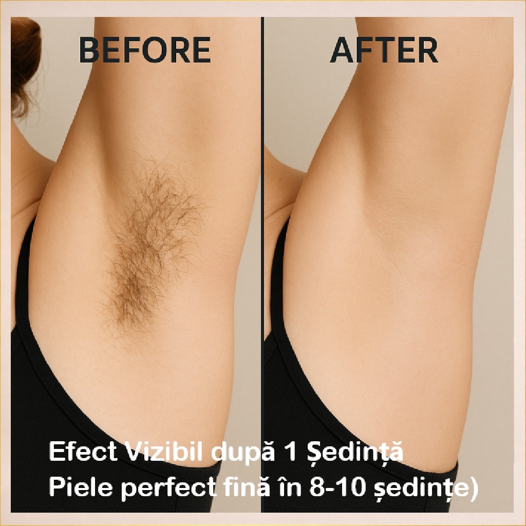 WhatsApp Image 2026-02-18 at 14.20.23 (2) epilare-definitiva-laser-dioda-bistrita